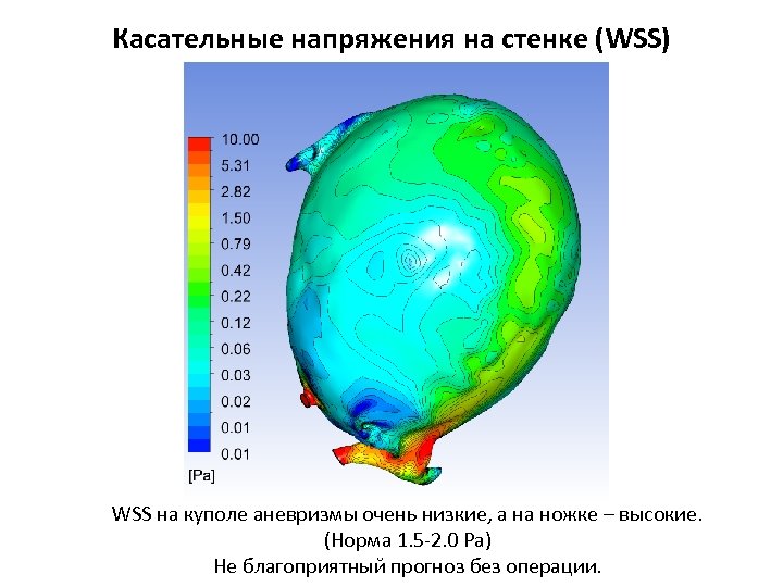 Касательные напряжения на стенке (WSS) WSS на куполе аневризмы очень низкие, а на ножке