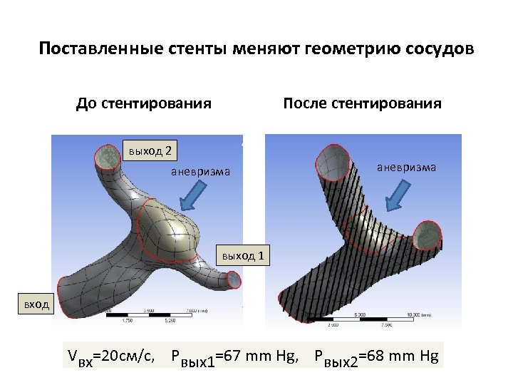 Поставленные стенты меняют геометрию сосудов До стентирования После стентирования выход 2 аневризма выход 1
