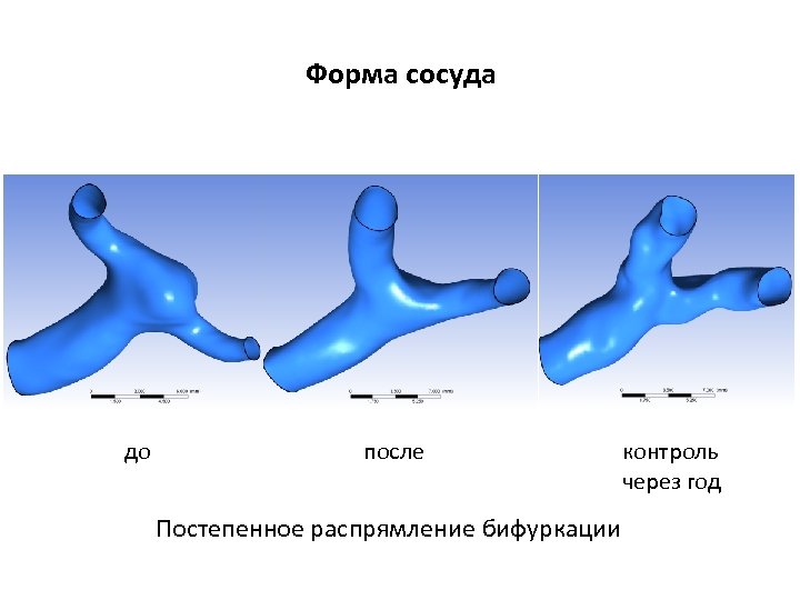 Форма сосуда до после Постепенное распрямление бифуркации контроль через год 