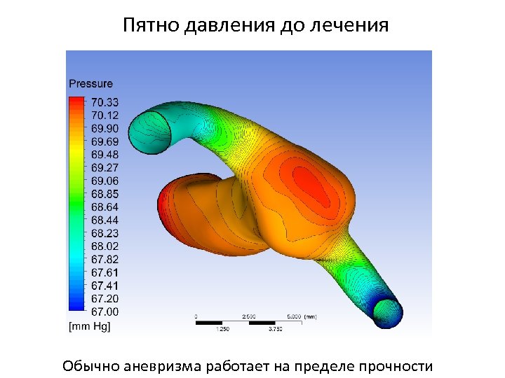 Пятно давления до лечения Обычно аневризма работает на пределе прочности 