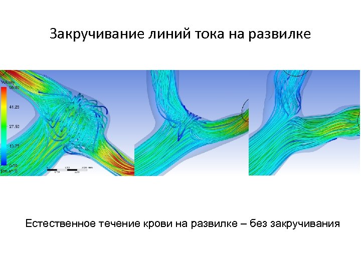 Закручивание линий тока на развилке Естественное течение крови на развилке – без закручивания 