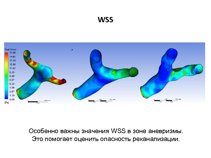 WSS Особенно важны значения WSS в зоне аневризмы. Это помогает оценить опасность реканализации. 