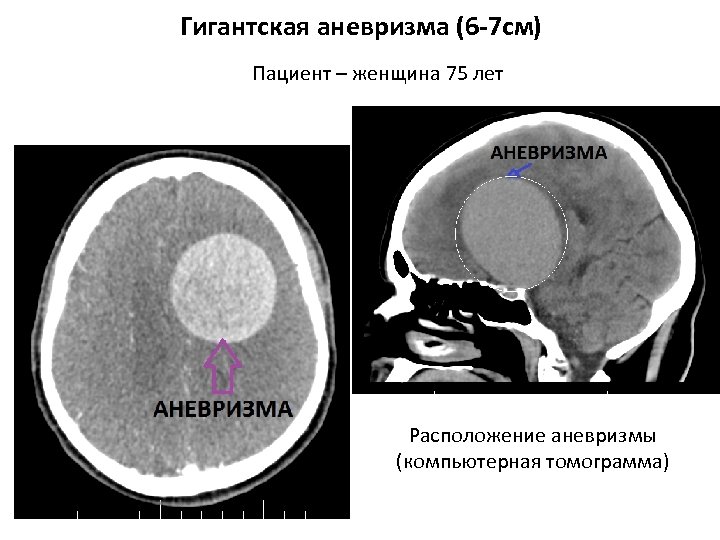Гигантская аневризма (6 -7 см) Пациент – женщина 75 лет Расположение аневризмы (компьютерная томограмма)