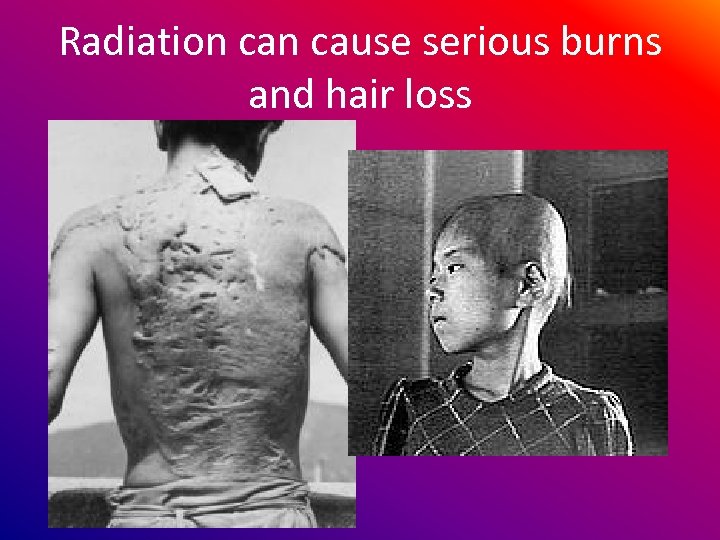 Radiation cause serious burns and hair loss 