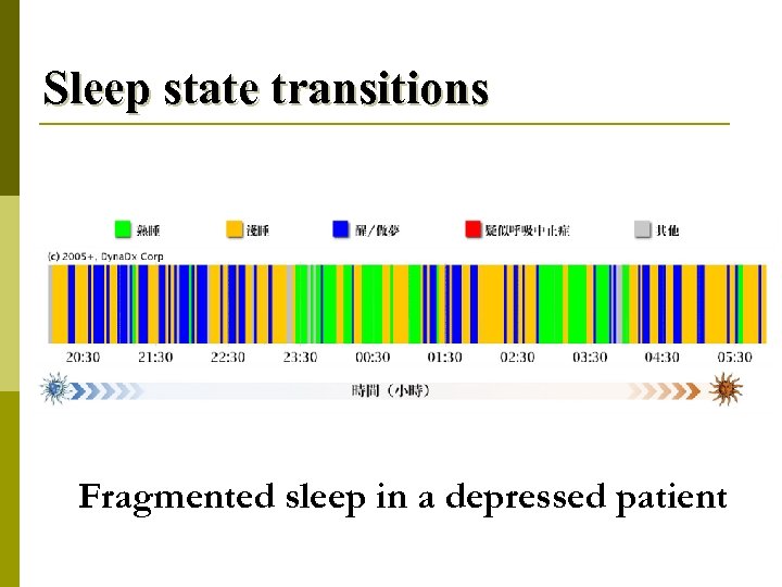 Sleep state transitions Fragmented sleep in a depressed patient 