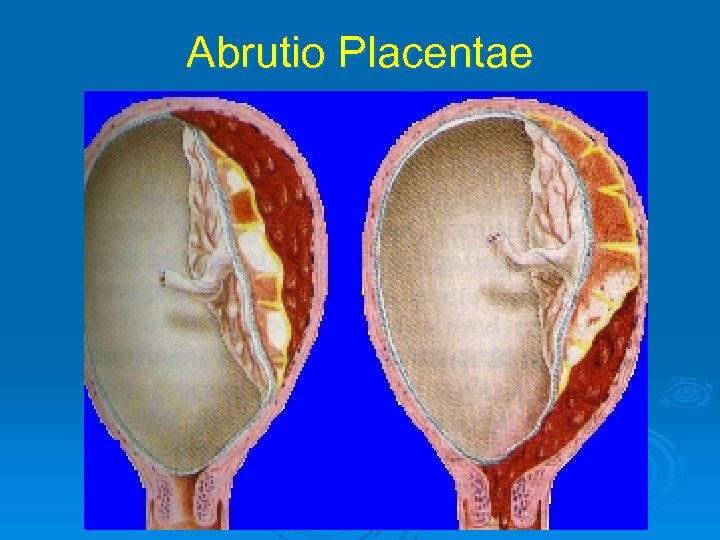 Abrutio Placentae 