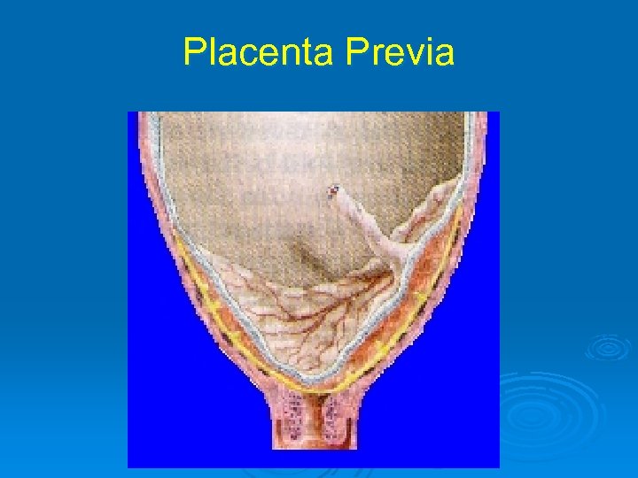 Placenta Previa 