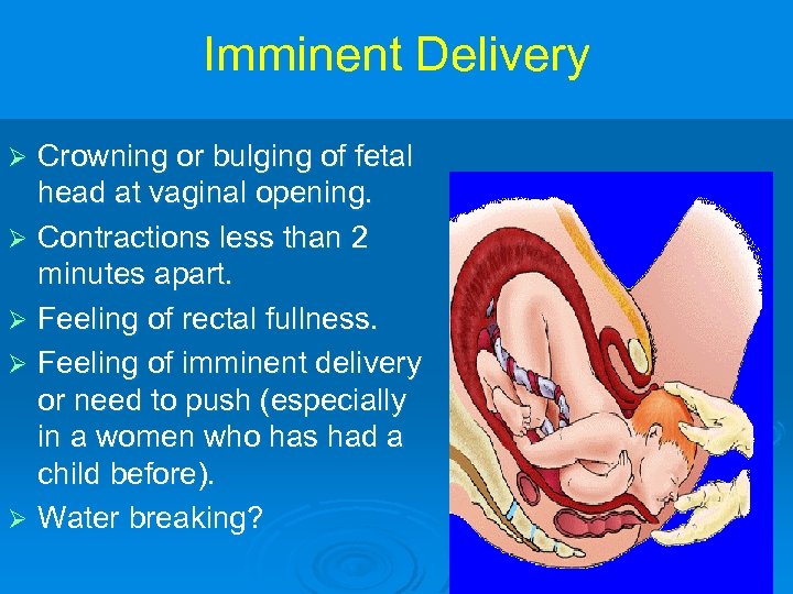Imminent Delivery Crowning or bulging of fetal head at vaginal opening. Ø Contractions less