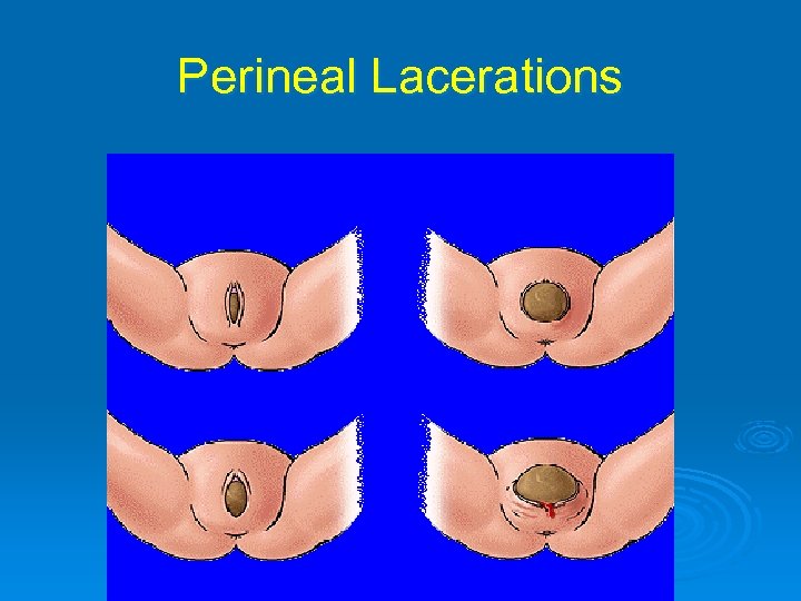 Perineal Lacerations 