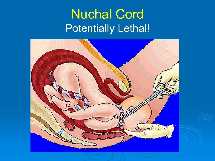 Nuchal Cord Potentially Lethal! 
