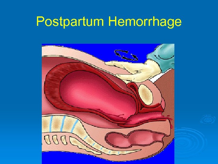Postpartum Hemorrhage 