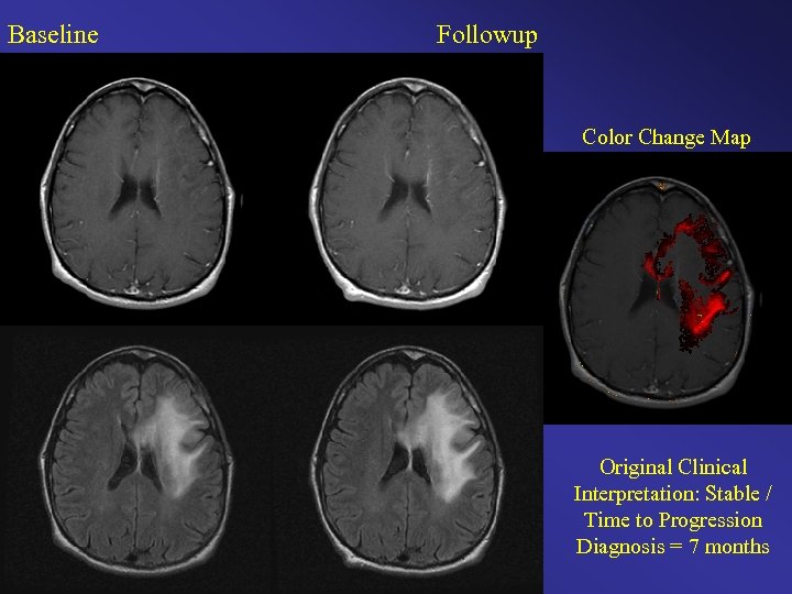 Baseline Followup Color Change Map Original Clinical Interpretation: Stable / Time to Progression Diagnosis