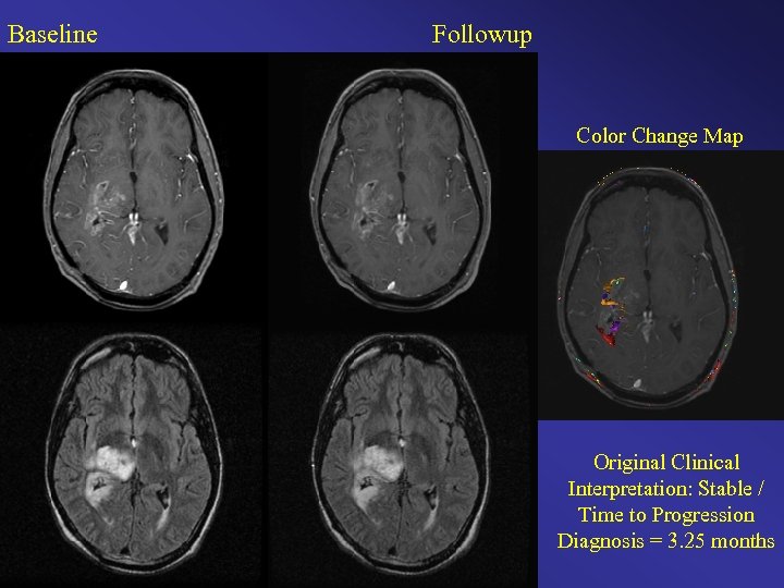 Baseline Followup Color Change Map Original Clinical Interpretation: Stable / Time to Progression Diagnosis