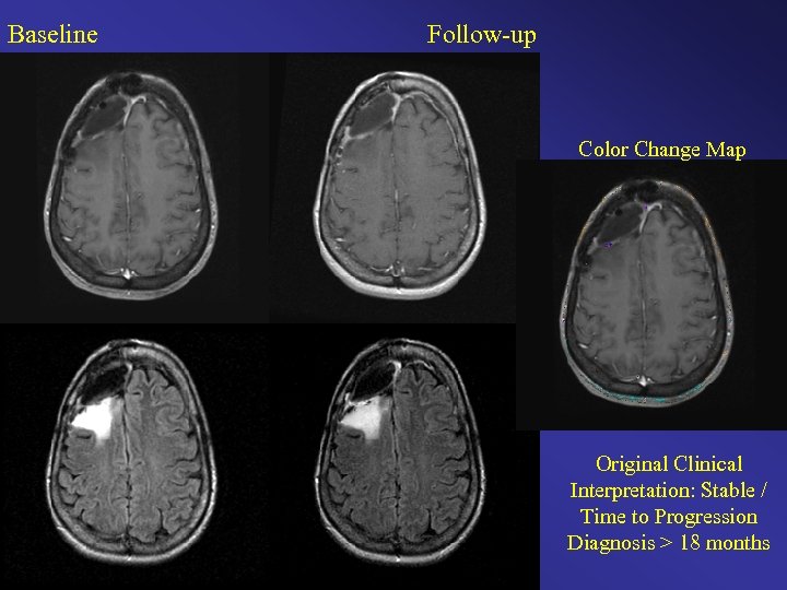 Baseline Follow-up Color Change Map Original Clinical Interpretation: Stable / Time to Progression Diagnosis