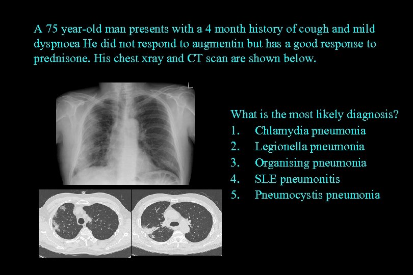 A 75 year-old man presents with a 4 month history of cough and mild