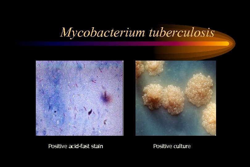 Mycobacterium tuberculosis Positive acid-fast stain Positive culture 