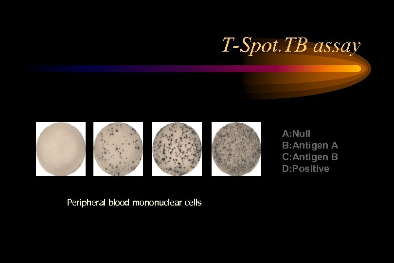 T-Spot. TB assay A B C Peripheral blood mononuclear cells D A: Null B: