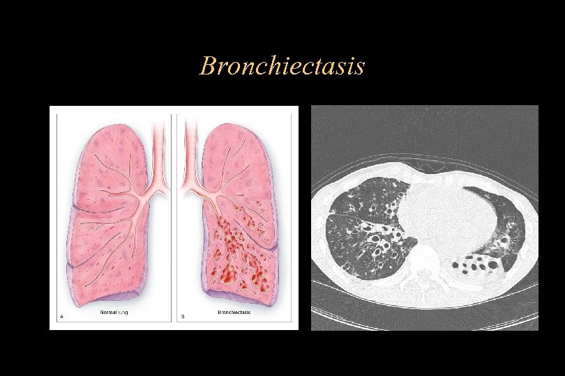 Bronchiectasis 