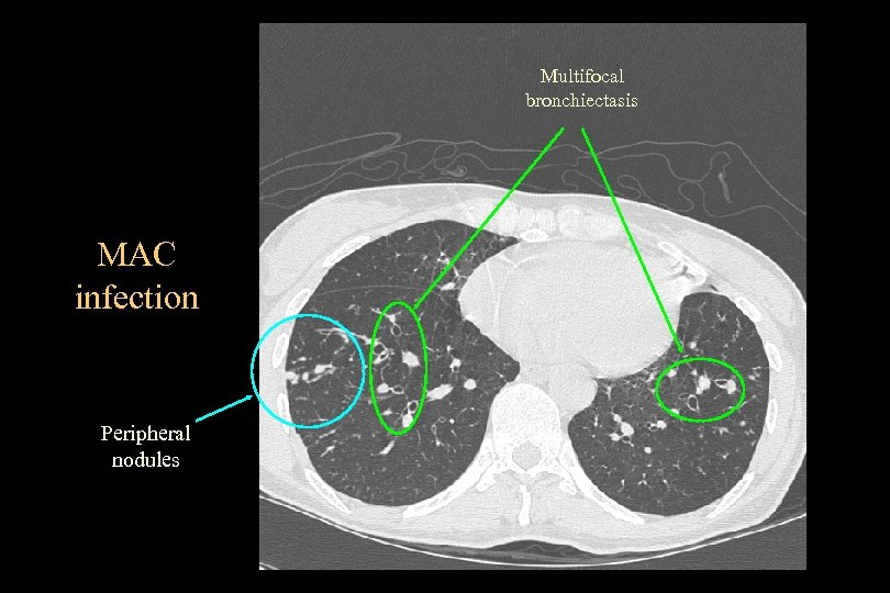 Multifocal bronchiectasis MAC infection Peripheral nodules 