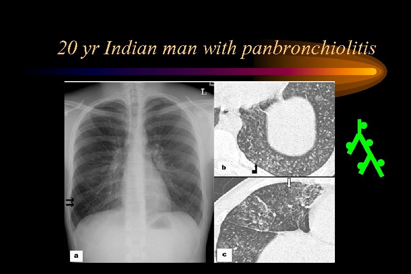 20 yr Indian man with panbronchiolitis 