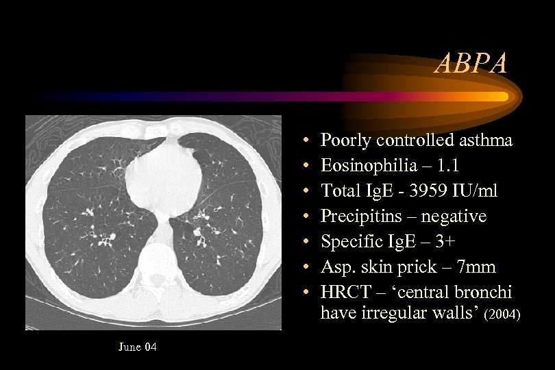 ABPA • • June 04 Poorly controlled asthma Eosinophilia – 1. 1 Total Ig.