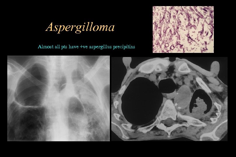 Aspergilloma Almost all pts have +ve aspergillus precipitins 