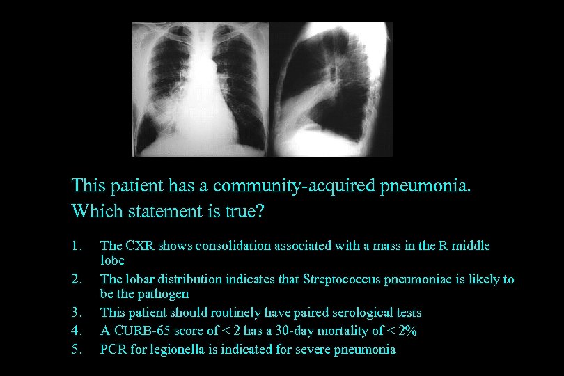 This patient has a community-acquired pneumonia. Which statement is true? 1. 2. 3. 4.