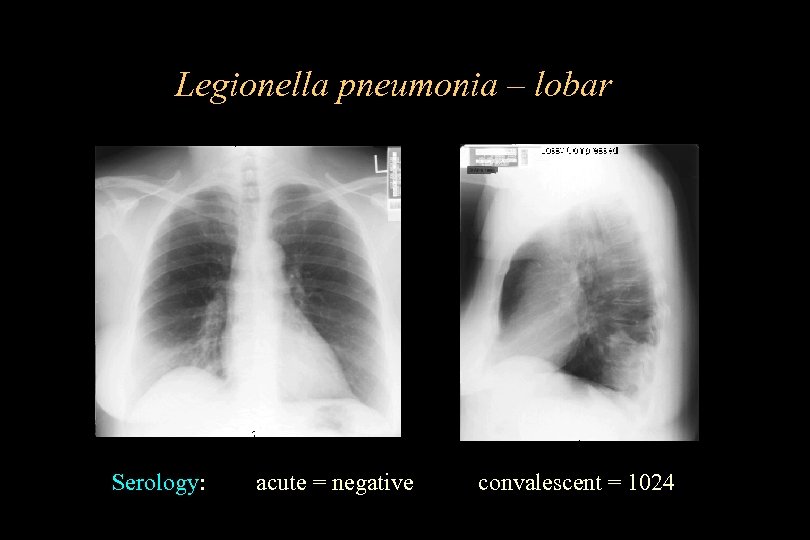 Legionella pneumonia – lobar Serology: acute = negative convalescent = 1024 