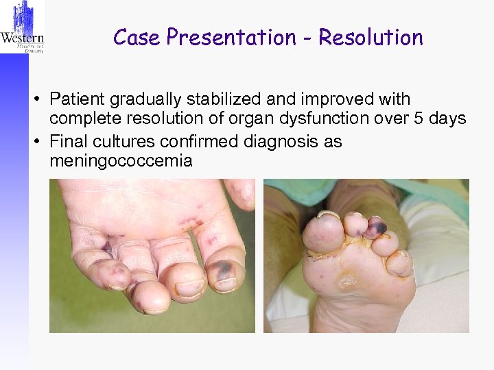 Case Presentation - Resolution • Patient gradually stabilized and improved with complete resolution of