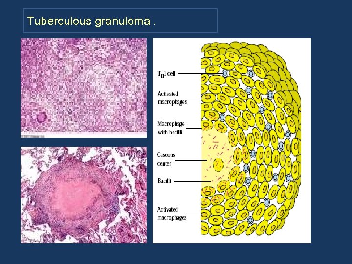 Tuberculous granuloma. 