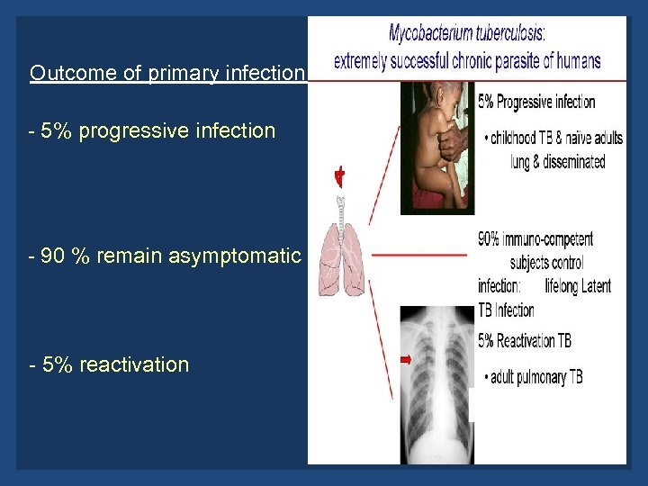 Outcome of primary infection : - 5% progressive infection - 90 % remain asymptomatic