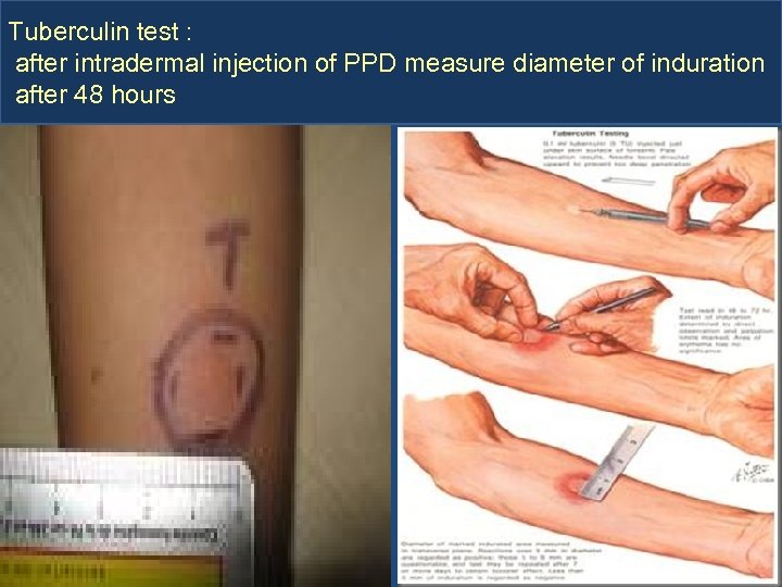 Tuberculin test : after intradermal injection of PPD measure diameter of induration after 48