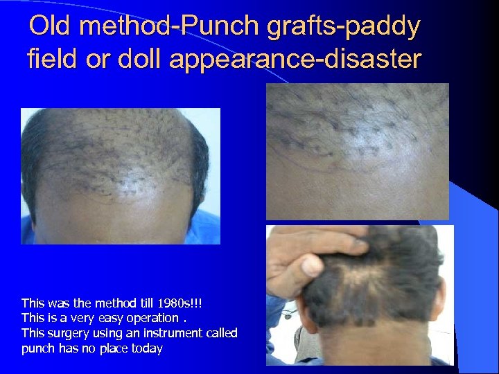 Old method-Punch grafts-paddy field or doll appearance-disaster This was the method till 1980 s!!!