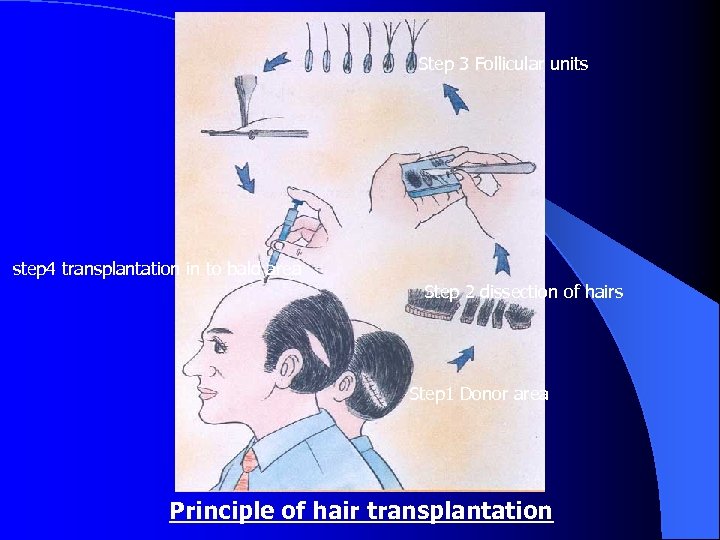 Step 3 Follicular units step 4 transplantation in to bald area Step 2 dissection