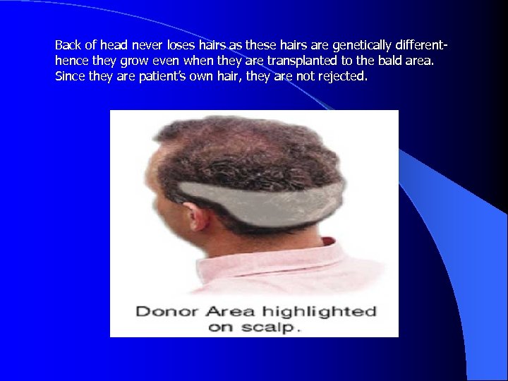 Back of head never loses hairs as these hairs are genetically differenthence they grow