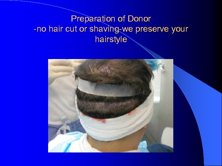 Preparation of Donor -no hair cut or shaving-we preserve your hairstyle 