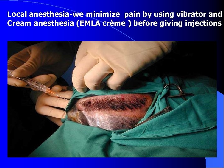 Local anesthesia-we minimize pain by using vibrator and Cream anesthesia (EMLA crème ) before