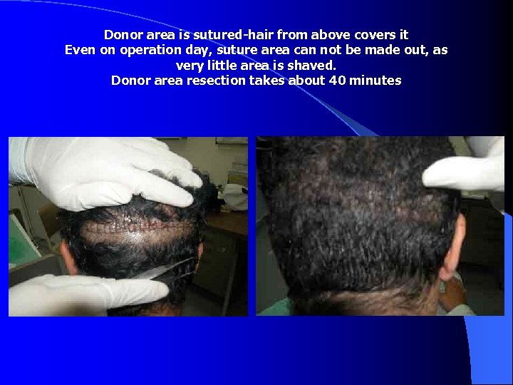 Donor area is sutured-hair from above covers it Even on operation day, suture area