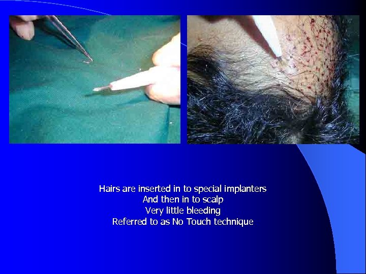 Hairs are inserted in to special implanters And then in to scalp Very little