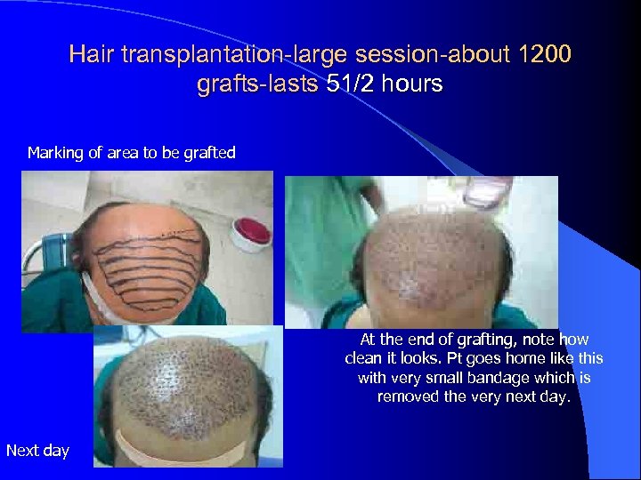 Hair transplantation-large session-about 1200 grafts-lasts 51/2 hours Marking of area to be grafted At