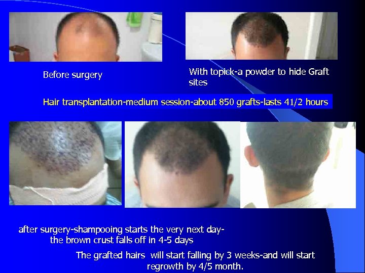 Before surgery With topick-a powder to hide Graft sites Hair transplantation-medium session-about 850 grafts-lasts