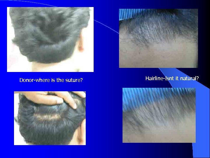 Donor-where is the suture? Hairline-Isnt it natural? 