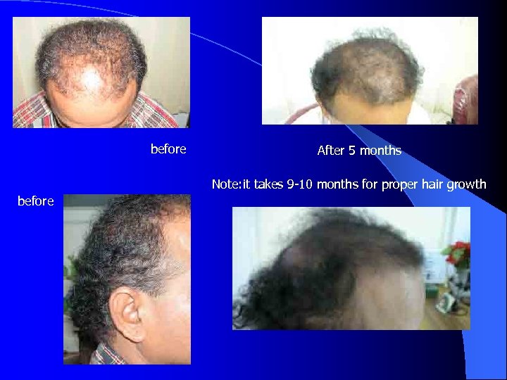 before After 5 months Note: it takes 9 -10 months for proper hair growth