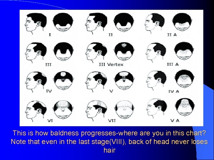 This is how baldness progresses-where are you in this chart? Note that even in