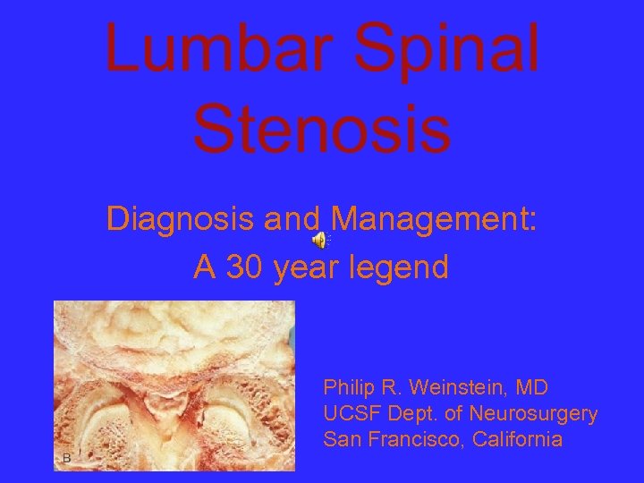 Lumbar Spinal Stenosis Diagnosis and Management: A 30 year legend Philip R. Weinstein, MD