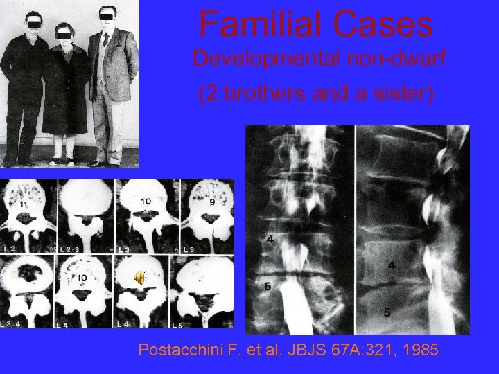 Familial Cases Developmental non-dwarf (2 brothers and a sister) Postacchini F, et al, JBJS