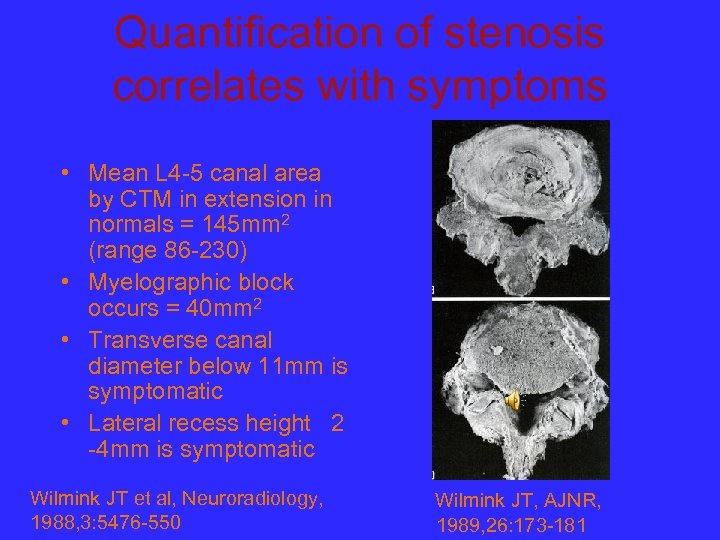 Quantification of stenosis correlates with symptoms • Mean L 4 -5 canal area by