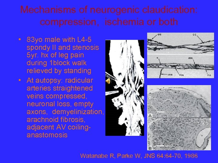 Mechanisms of neurogenic claudication: compression, ischemia or both • 83 yo male with L