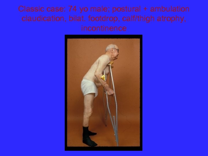 Classic case: 74 yo male; postural + ambulation claudication, bilat. footdrop, calf/thigh atrophy, incontinence