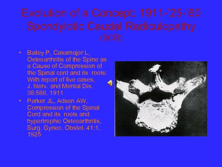 Evolution of a Concept: 1911 -’ 25 -’ 60 Spondylotic Caudal Radiculopathy (SCR) •